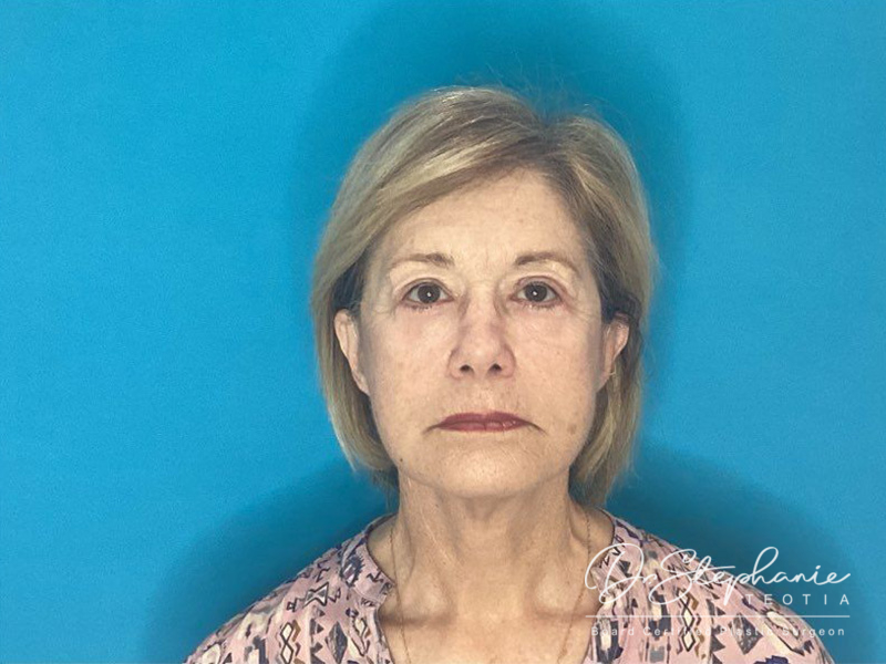 after facelift front view female patient case 3957