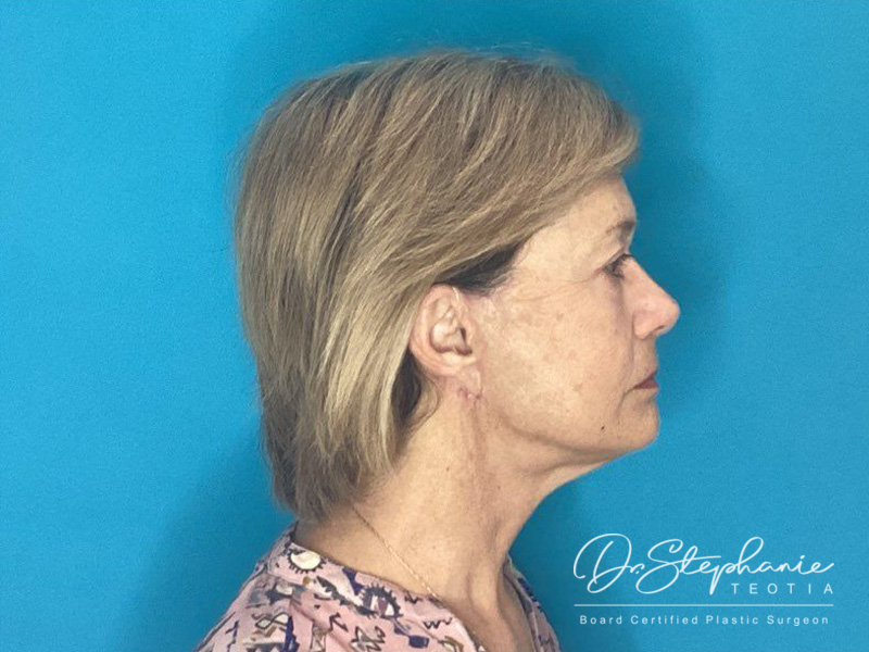 after facelift side view female patient case 3957