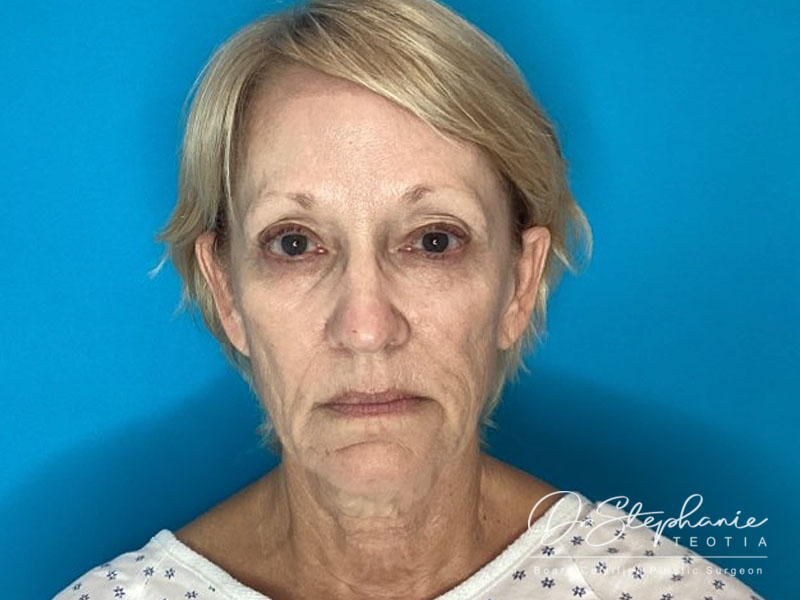 before facelift front view female patient case 4479