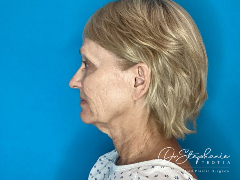 before facelift side view female patient case 4479
