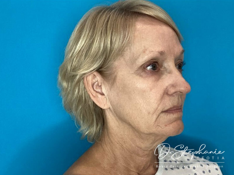 before facelift angle view female patient case 4479