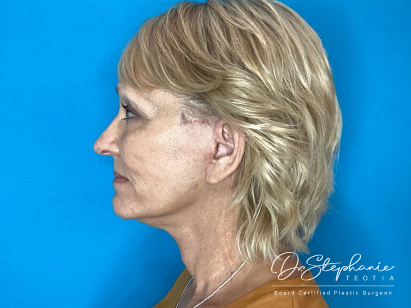 after facelift side view female patient case 4479