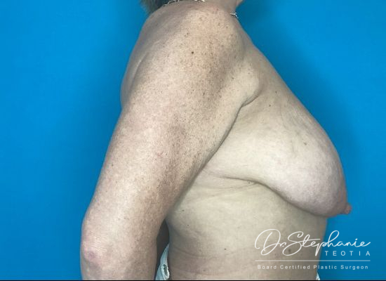 before breast reduction right side view female patient case 4530