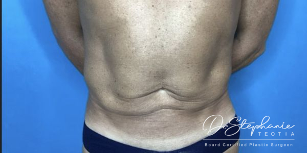 after liposuction of the abdomen front view male patient front view case 4927