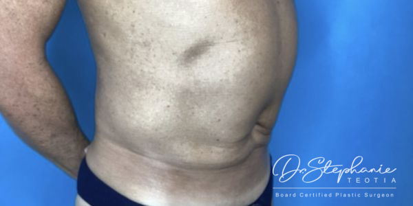 after liposuction of the abdomen front view male patient side view case 4927