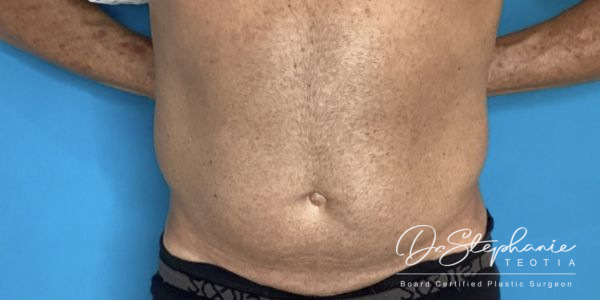 before liposuction of the abdomen front view male patient front view case 4927
