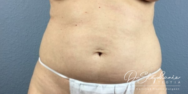 before liposuction of the abdomen female patient front view case 4943