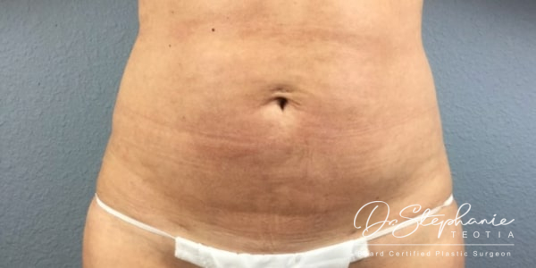after liposuction of the abdomen female patient front view case 4943