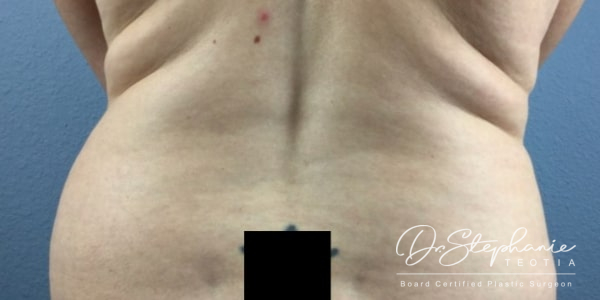 before liposuction of the abdomen female patient back view case 4943