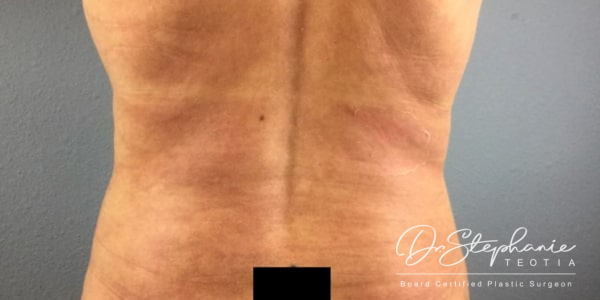 after liposuction of the abdomen female patient back view case 4943