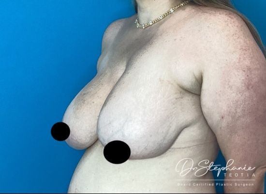 before breast reduction left angle view female patient case 5198