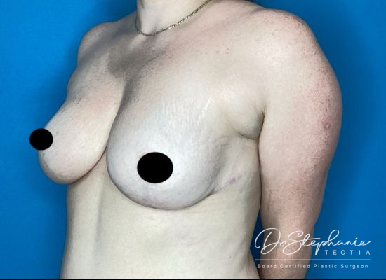 after breast reduction left angle view female patient case 5198