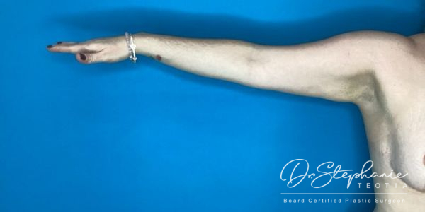 after arm liposuction right arm view female patient case 5207