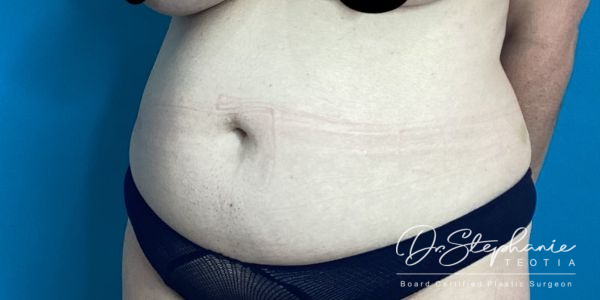 before abdominal liposuction angle view female patient case 5212