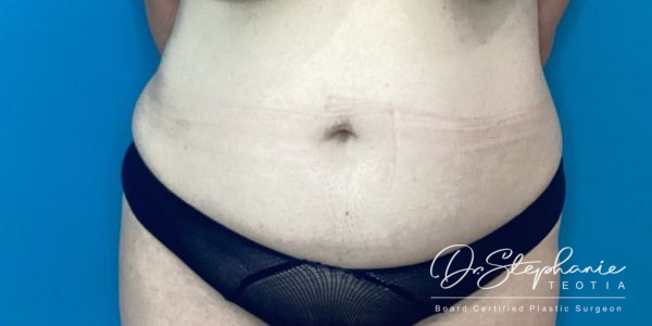 before abdominal liposuction front view female patient case 5212