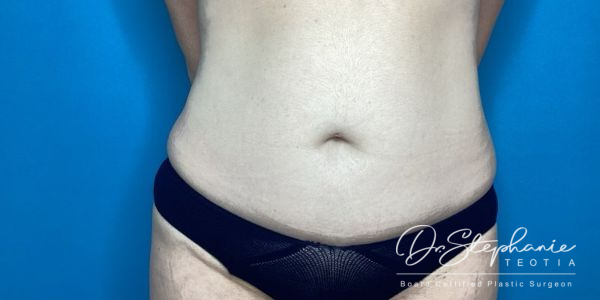 after abdominal liposuction front view female patient case 5212